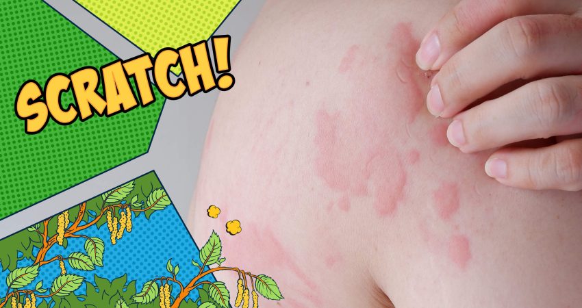Urticaria