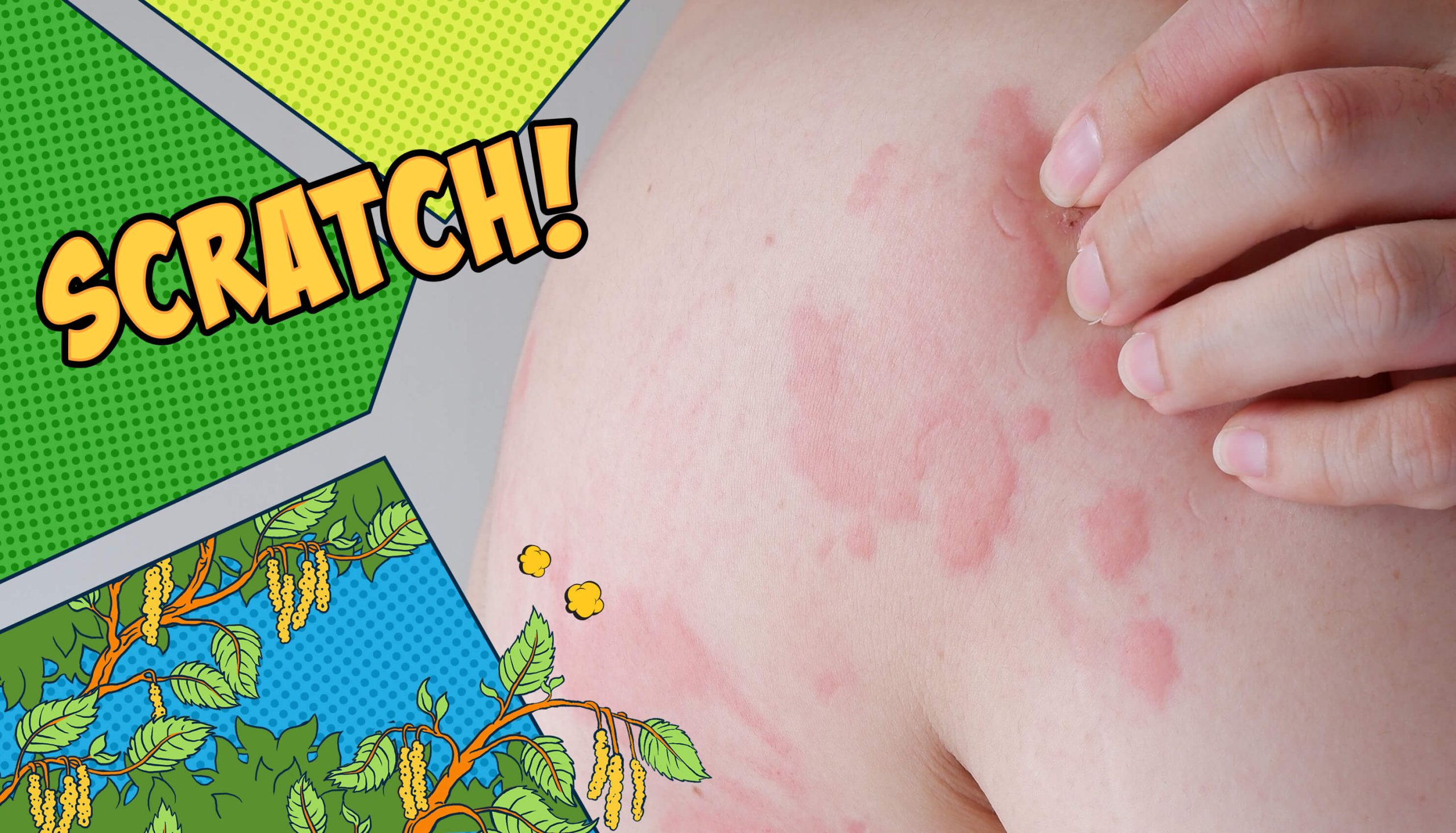 Urticaria